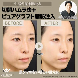 【局所麻酔代込み】切開ハムラ法+ピュアグラフト脂肪注入|黒クマのない明るい目元に