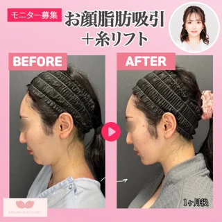 【院長 富田さくら執刀】 脂肪吸引（頬＋ジョール＋あご下）＋糸リフト｜麻酔代込｜女性医師担当