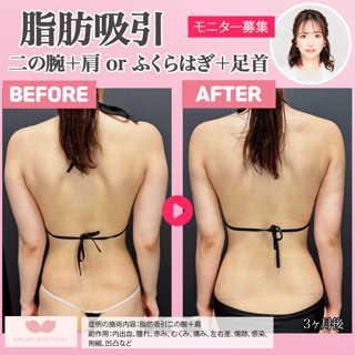 【院長 富田さくら執刀】　脂肪吸引｜二の腕＋肩 or ふくらはぎ＋足首　華奢な腕・美脚に