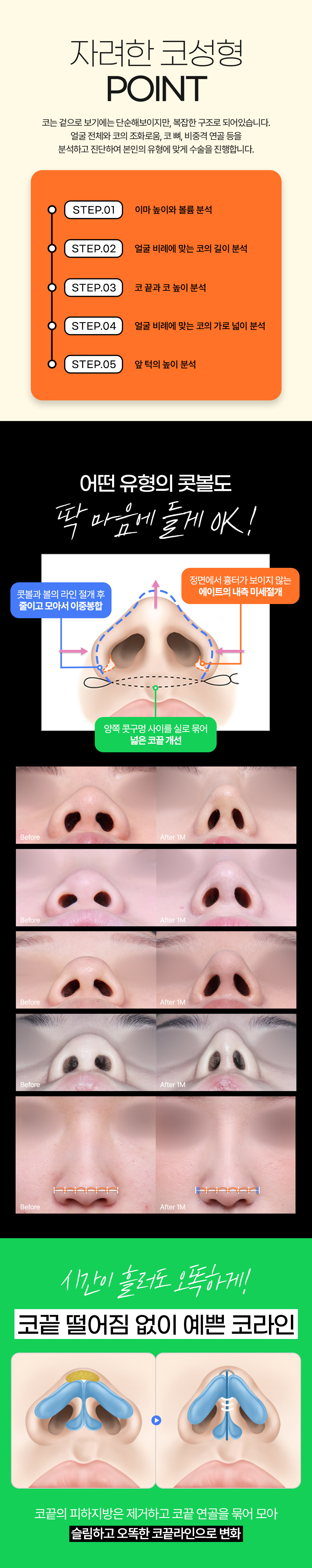 자연스럽고 화려한 직반라인&콧대부터 코끝까지 보정이 필요없는 에이트 코성형