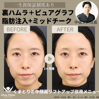 【局所麻酔代込み】裏ハムラ法+ピュアグラフト脂肪注入+ナゾラビアルファット除去+ミッドチークリフト4本