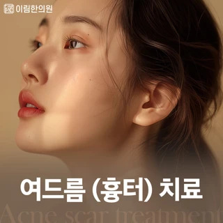 여드름 흉터 치료
