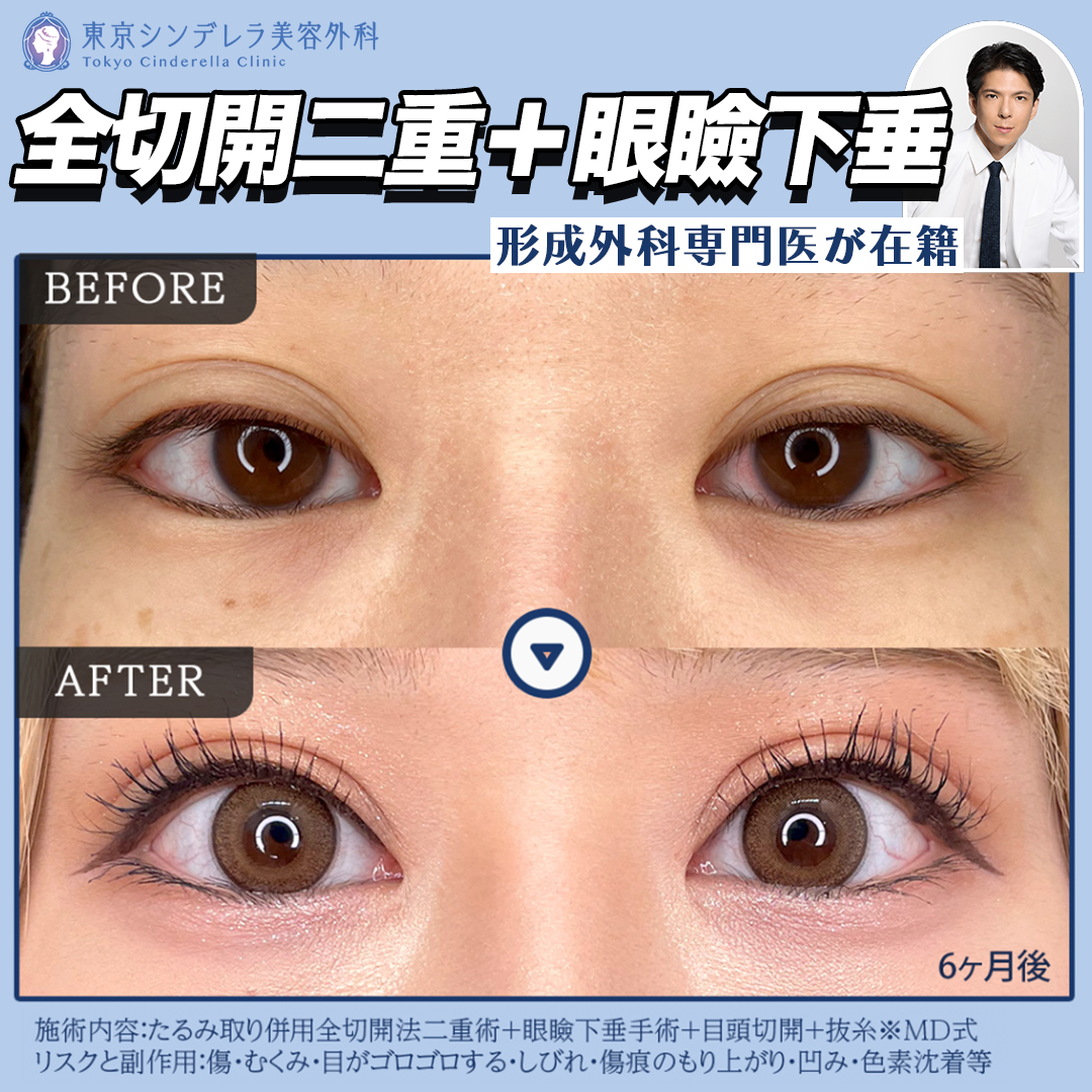 全切開二重＋眼瞼下垂《麻酔代込》最強目ヂカラセット◎《形成外科出身