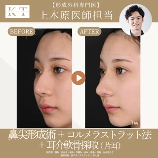【形成外科専門医 上木原医師担当】鼻整形（鼻尖形成術＋コルメラストラット法＋耳介軟骨採取（片耳））