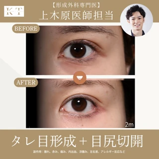 【形成外科専門医 上木原医師担当】タレ目形成＋目尻切開