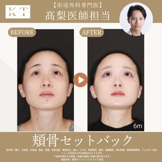 【形成外科専門医 髙梨医師担当】頬骨セットバック　アフターケア付き