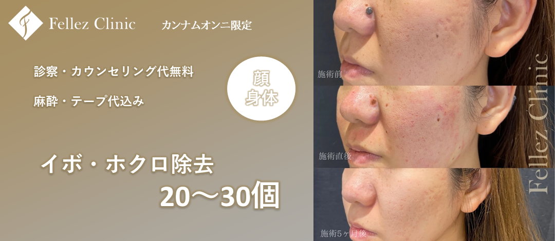 年間8万個の除去実績あり◎】ホクロ除去｜20個～｜顔も身体問わず選択