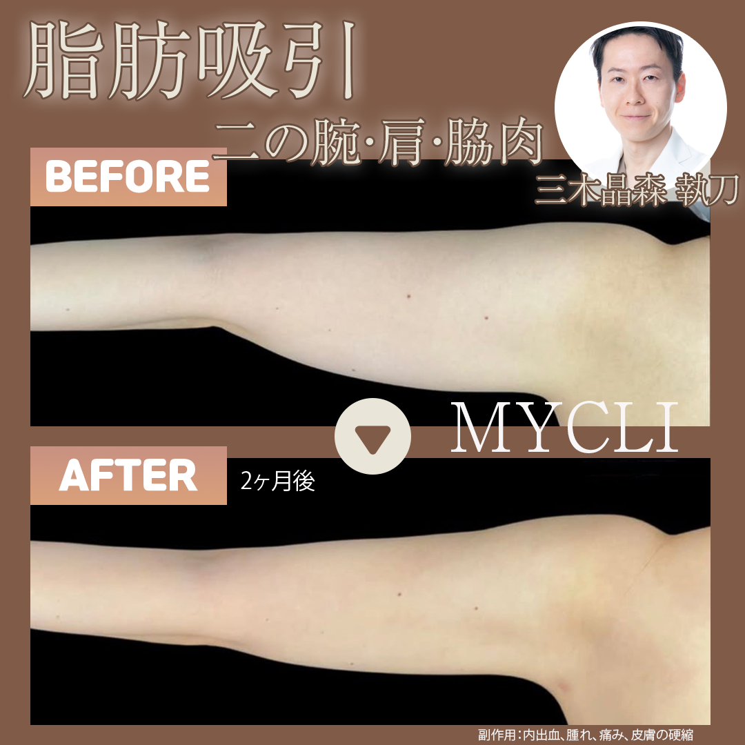 脂肪吸引（頬＋顎下／二の腕肩セット） | MYCLI【マイクリ】