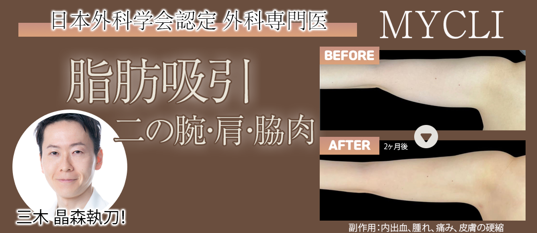 脂肪吸引（頬＋顎下／二の腕肩セット） | MYCLI【マイクリ】