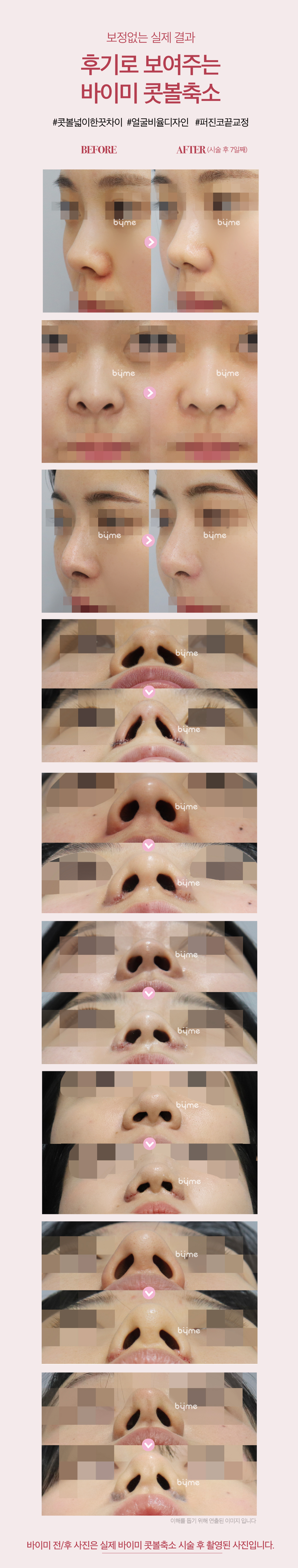 내가 원하는 방식으로 내가 원하는 만큼 넓은 복코 고민 교정하는 콧볼축소술