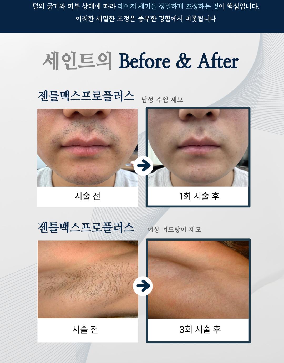 시술 원리
젠틀맥스 프로플러스는 알렉산드라이트(755nm)와 엔디야그(1064nm) 두 가지 파장을 활용한 레이저 장비로, 모낭에 선택적으로 열 에너지를 전달하여 모근을 파괴합니다. 피부 손상은 최소화하면서 모발만을 타겟으로 하여 안전하고 효과적인 제모가 가능합니다.
시술 효과
굵고 짙은 털부터 잔털까지 폭넓은 부위 제모 가능
시술 직후 매끈한 피부결 개선
반복 시술 시 영구적 제모 효과 기대
제모뿐만 아니라 피부톤 개선 및 모공 축소에도 도움
정품·정량 안내
병원에서 사용하는 젠틀맥스 프로플러스 장비는 정품 인증 장비입니다.
모든 시술은 의학적 기준에 맞는 정량 에너지로 진행되며, 효과와 안전성을 보장합니다.
병원만의 특별한 장점
프라이빗 1인실 운영
편안한 공간에서 타인과의 마주침 없이 시술받을 수 있도록 1인실 시스템을 운영합니다.
원장님 직접 상담
경험 많은 원장님이 직접 진료 및 상담을 진행하여, 개인별 피부·모발 특성에 맞는 맞춤형 제모 계획을 제안합니다.
체계적 사후관리
시술 후 피부 진정 및 재생 케어 프로그램을 함께 제공하여, 제모 효과 극대화와 피부 건강을 동시에 관리합니다.