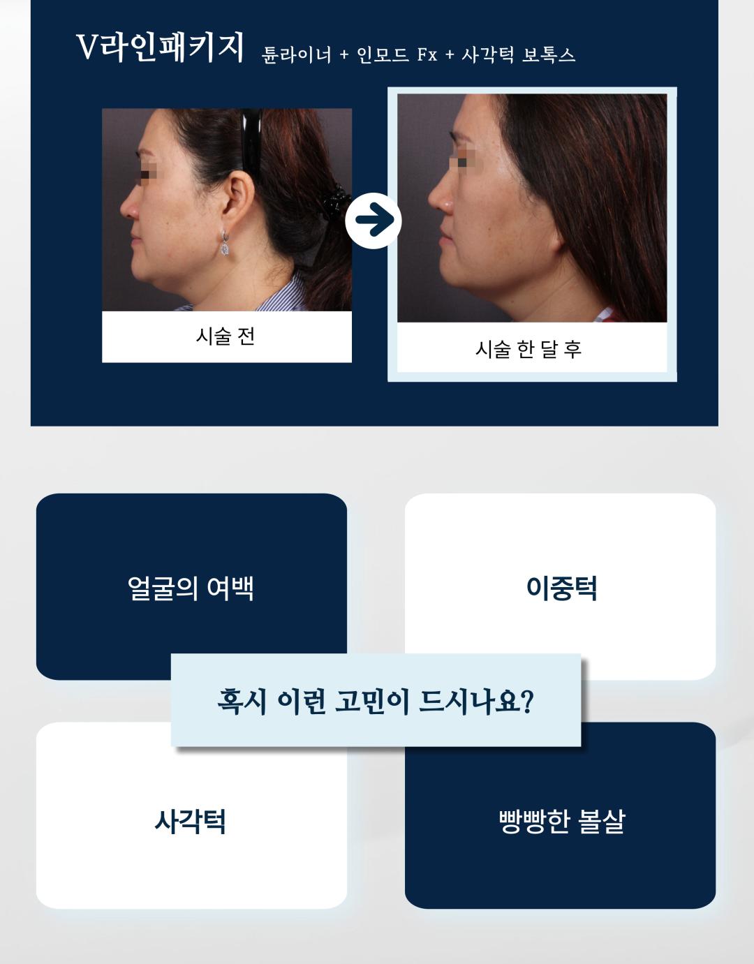 시술 원리
인모드 튠라이너: 고주파 에너지를 피부 속 진피와 피하지방층에 전달하여 콜라겐 재생을 촉진하고, 탄력을 높여 얼굴선을 정리합니다.
사각턱 보톡스: 발달한 교근(저작근)에 보톡스를 주사하여 근육 크기를 줄이고 갸름한 턱선을 만듭니다.
턱끝 필러: 부족한 턱끝 부위를 필러로 채워 균형 잡힌 턱 라인을 만듭니다.
인모드 FX: 고주파와 미세침을 동시에 이용해 피부 속 지방세포를 줄이고, 리프팅과 피부결 개선을 동시에 유도합니다.
시술 효과
갸름한 V라인 턱선 형성
턱끝 개선으로 세련되고 균형 잡힌 인상
피부 탄력 증가 및 얼굴 라인 정리
과도한 교근 발달 개선 → 얼굴이 작아 보이는 효과
정품·정량 안내
세인트의원은 정품·정량 원칙을 준수합니다.
모든 보톡스·필러는 정품 인증된 제품만 사용합니다.
인모드 및 튠라이너 장비 또한 정식 인증 장비만 사용합니다.
병원만의 특별한 장점
모든 시술은 1인실 프라이빗 공간에서 진행 → 편안하고 안전한 환경 제공
모든 과정에서 대표원장 직접 상담 및 시술 관리 → 맞춤형 진료 가능