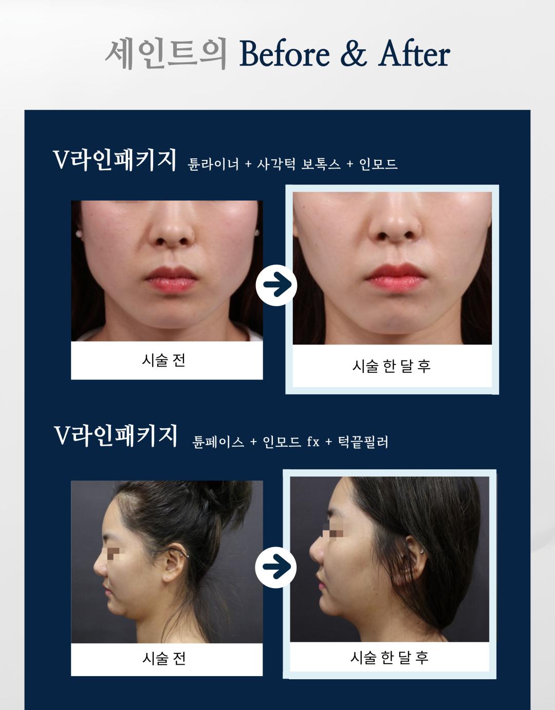 시술 원리
인모드 튠라이너: 고주파 에너지를 피부 속 진피와 피하지방층에 전달하여 콜라겐 재생을 촉진하고, 탄력을 높여 얼굴선을 정리합니다.
사각턱 보톡스: 발달한 교근(저작근)에 보톡스를 주사하여 근육 크기를 줄이고 갸름한 턱선을 만듭니다.
턱끝 필러: 부족한 턱끝 부위를 필러로 채워 균형 잡힌 턱 라인을 만듭니다.
인모드 FX: 고주파와 미세침을 동시에 이용해 피부 속 지방세포를 줄이고, 리프팅과 피부결 개선을 동시에 유도합니다.
시술 효과
갸름한 V라인 턱선 형성
턱끝 개선으로 세련되고 균형 잡힌 인상
피부 탄력 증가 및 얼굴 라인 정리
과도한 교근 발달 개선 → 얼굴이 작아 보이는 효과
정품·정량 안내
세인트의원은 정품·정량 원칙을 준수합니다.
모든 보톡스·필러는 정품 인증된 제품만 사용합니다.
인모드 및 튠라이너 장비 또한 정식 인증 장비만 사용합니다.
병원만의 특별한 장점
모든 시술은 1인실 프라이빗 공간에서 진행 → 편안하고 안전한 환경 제공
모든 과정에서 대표원장 직접 상담 및 시술 관리 → 맞춤형 진료 가능