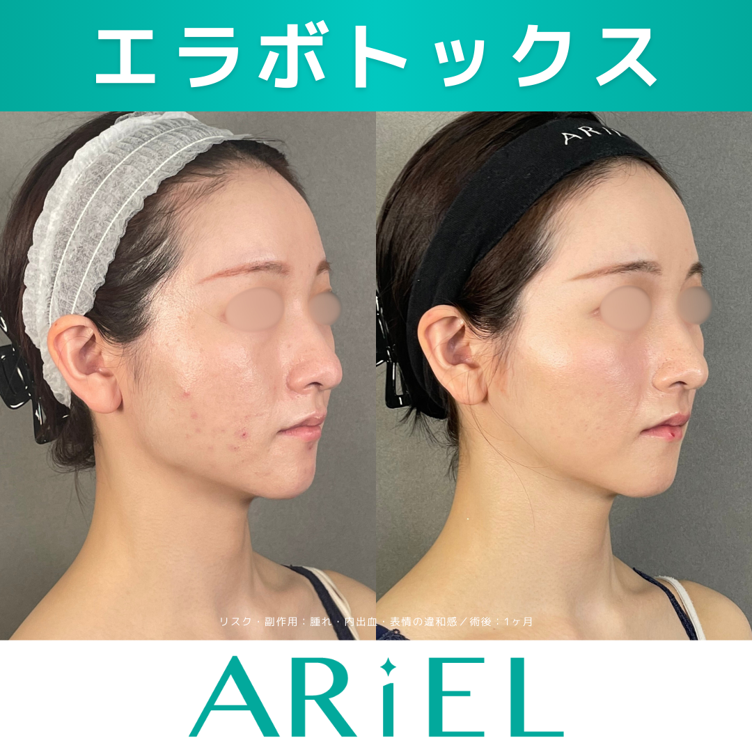 エラボトックス注射｜ 40単位 | アリエル美容クリニック 郡山院, image size:1080x1080
