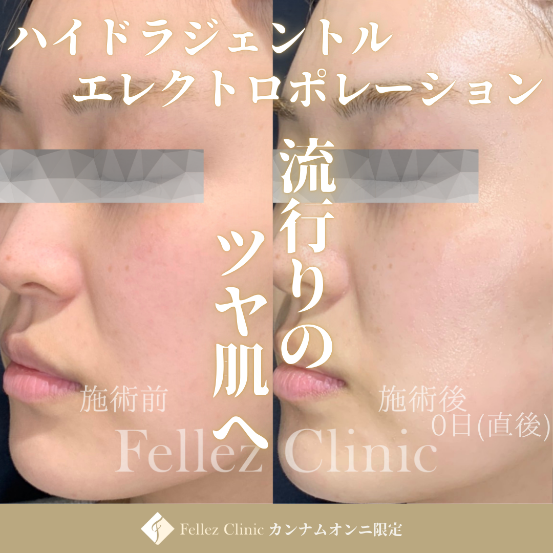 透明感・ハリ艶肌に！毛穴洗浄・導入施術』ハイドラジェントル＋8種の