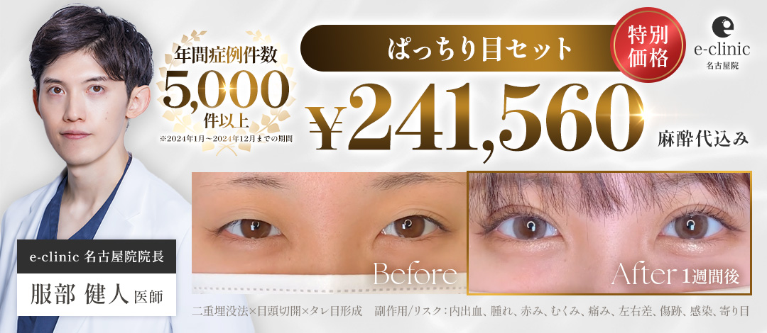 モニター】ぱっちり目セット【二重埋没＋目頭切開、目尻切開 