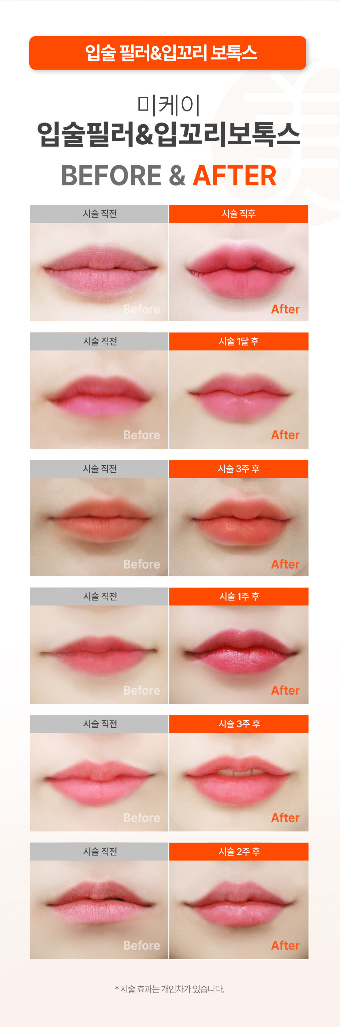 미케이 필러 POINT
광대와 하관의 밸런스
울퉁불퉁하지 않은 라인
대칭을 이룬 자연스러운 볼륨
