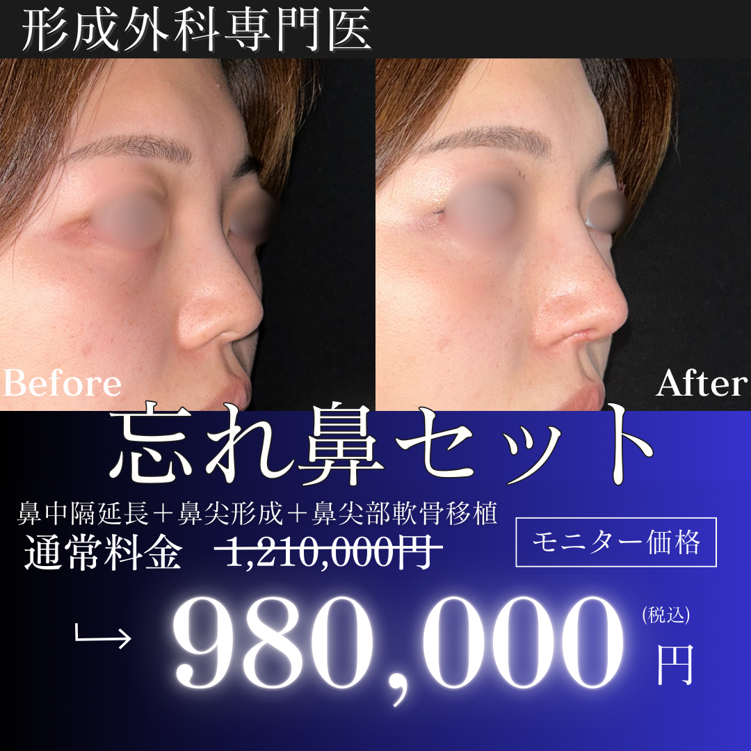 形成外科専門医】忘れ鼻セット｜鼻中隔延長＋鼻尖形成＋鼻尖部軟骨移植｜理想に導く | KIMI CLINIC【キミクリニック】, image size:1080x1080