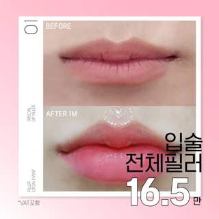 추가금없는 입술 전체 필러
