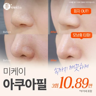 미케이 1대1 맞춤 각질&모공 청소 _아쿠아필