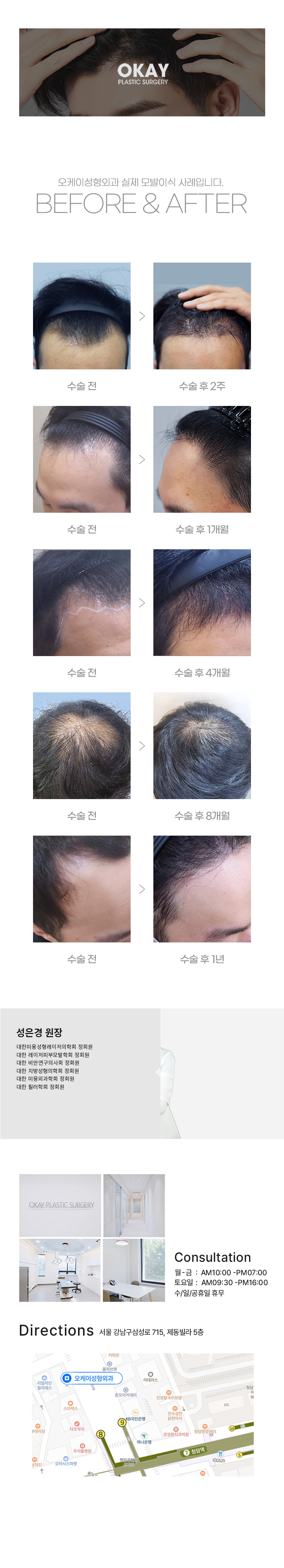 넓은이마, M자이마, 탈모, 헤어라인이식, 모발이식 모두 ok