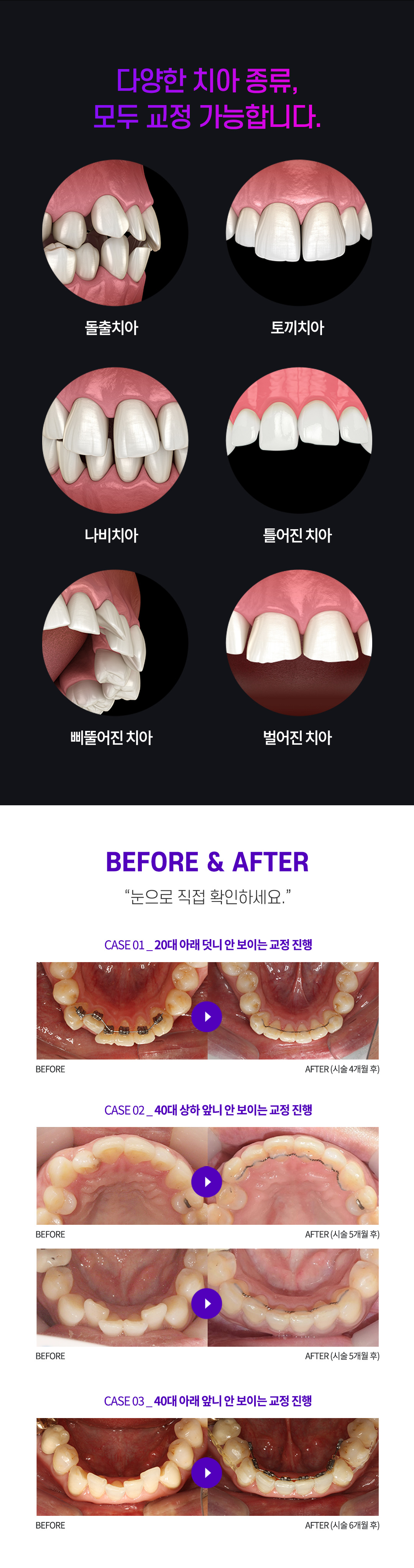 치과교정과 전문의가 직접 진료하는 심미교정, 안 보이는 앞니교정.