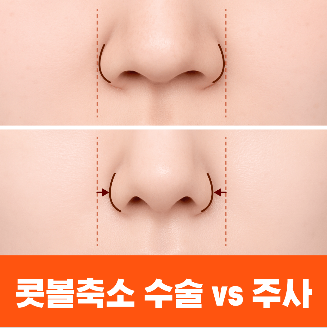 콧볼축소, 주사로 해결 가능? 효과·가격·후기·부작용 완벽정리