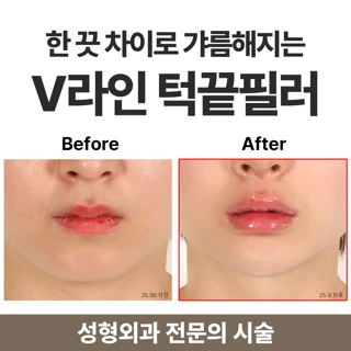 V라인 턱끝 필러
