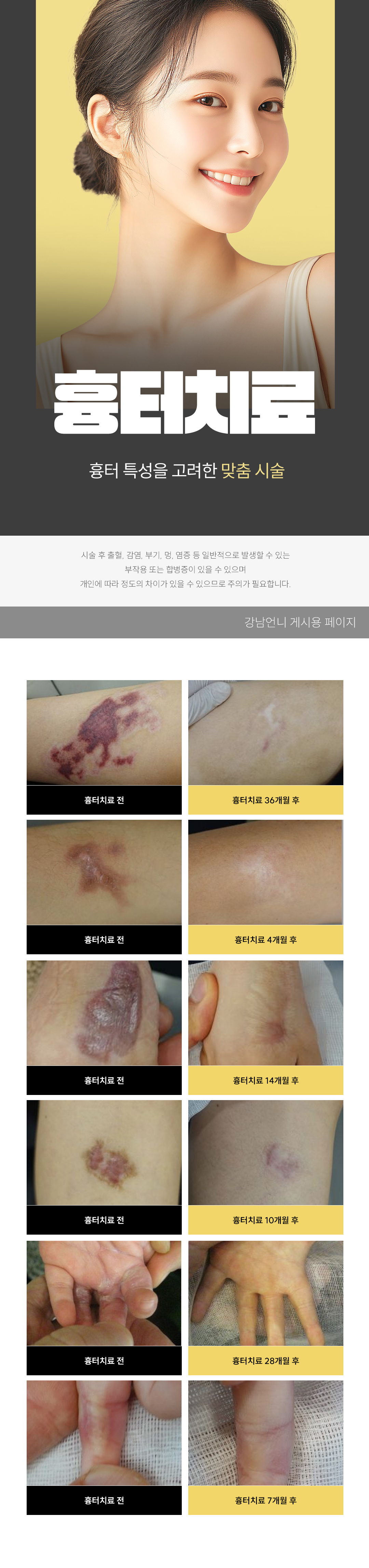 * 시술 설명 및 효과
- 20년 이상 상처와 흉터 위주로 진료한 본원만의 특별한 흉터 시술
- 울퉁불퉁한 반흔 흉터는 유착 부위를 끊어내고 회복 시키기를 반복하여 융기된 부분을 가라앉힘
- 무리한 흉터 치료가 아닌 흉터 재형성기의 특성을 고려한 맞춤 시술
- 원장님 직접 상담