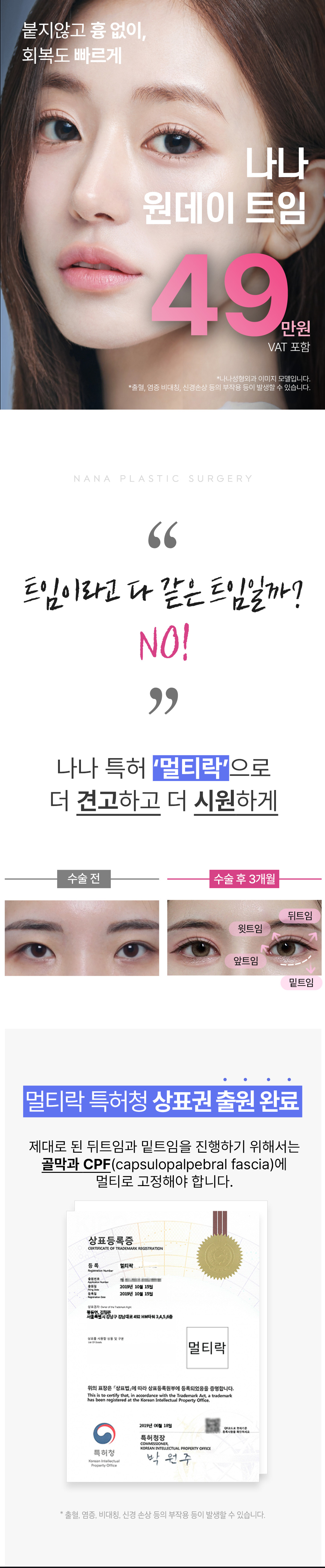 당일 세안,메이크업,렌즈착용가능 하루만에 순싹커지는 원데이트임_앞트임, 위트임, 뒤트임, 밑트임, 눈꼬리내리기 중 선택