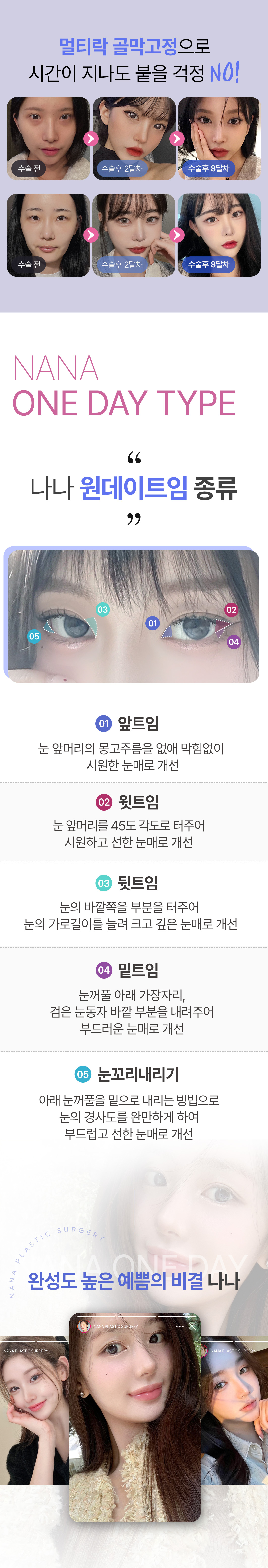 당일 세안,메이크업,렌즈착용가능 하루만에 순싹커지는 원데이트임_앞트임, 위트임, 뒤트임, 밑트임, 눈꼬리내리기 중 선택