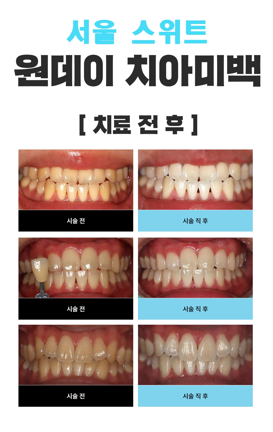 사용 미백제 : 오스템 뷰티스 미백제 사용
* 치아 미백 진행과정 *
스케일링 & 착색제거 ( 필요 시 건강 보험료 별도로 발생합니다. ** 본인부담금 30% 납부 필요 ) 
-----> 잇몸 보호제 도포 ---------> 미백제 도포  [ 정량 도포 원칙으로 섬세하게 도포합니다. ] ----------> 광조사 - 원데이 미백 ( 3회 기준 1시간 20분 소요 )

※ 치아미백은 시술 직 후 보다 일주일 후에 점 차 밝아지므로 일주일 정도는 착색위험 음식을 자제해주셔야합니다 예) 커피, 녹차, 와인, 떡볶이, 고추장찌개, 초콜릿 등등
또한 불특정 치아에서 약간의 찌릿찌릿한 시린 통증이 오기도 하지만 2~3일 이내로 안정을 찾으니 이와같은 반응은 걱정하지 않으셔도 됩니다. 