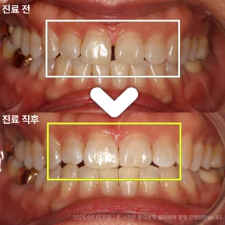 벌어진 앞니 당일완성 레진