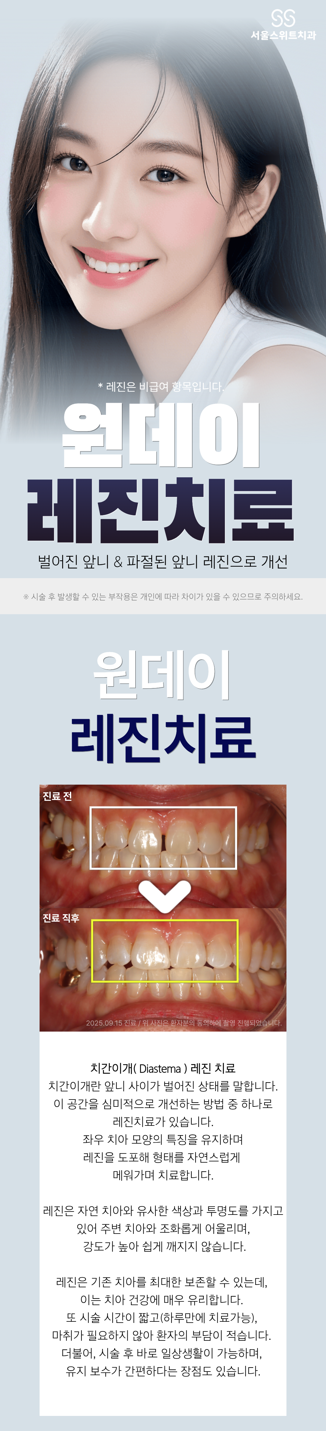 이 진료는 모든 환자분들께 적용할 수 있는 것은 아닙니다. 공간이 너무 크거나 접근이 용이하지 않는 경우에는 레진만으로는 충분한 지지력을 얻기 어렵기 때문에 추가적인 조치가 필요할 수 있어 병원에 내원하셔서 원장님과 상담 후 진료확정됩니다.
앞니에 적합한 진료입니다, 어금니 공간을 매우기 위해서는 보철 수복진료가 필요할 경우가 큽니다. ( 원장님과 상담 후 진료 방향이 결정됩니다. )
