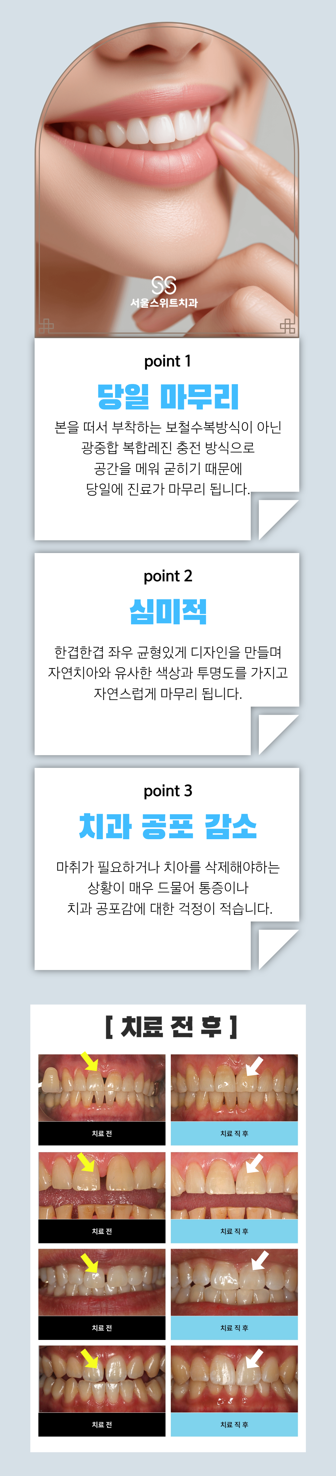 이 진료는 모든 환자분들께 적용할 수 있는 것은 아닙니다. 공간이 너무 크거나 접근이 용이하지 않는 경우에는 레진만으로는 충분한 지지력을 얻기 어렵기 때문에 추가적인 조치가 필요할 수 있어 병원에 내원하셔서 원장님과 상담 후 진료확정됩니다.
앞니에 적합한 진료입니다, 어금니 공간을 매우기 위해서는 보철 수복진료가 필요할 경우가 큽니다. ( 원장님과 상담 후 진료 방향이 결정됩니다. )