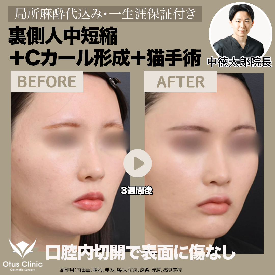 中顔面部 おすすめクリニック・値段の比較(2026) | カンナムオンニ
