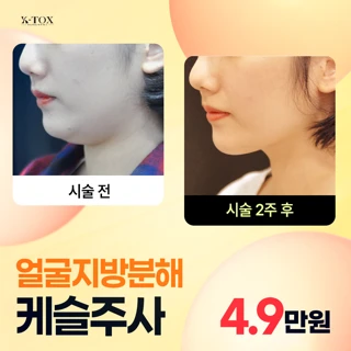 얼굴지방분해 케슬주사