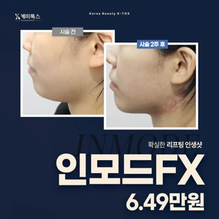V라인 리프팅-인모드FX