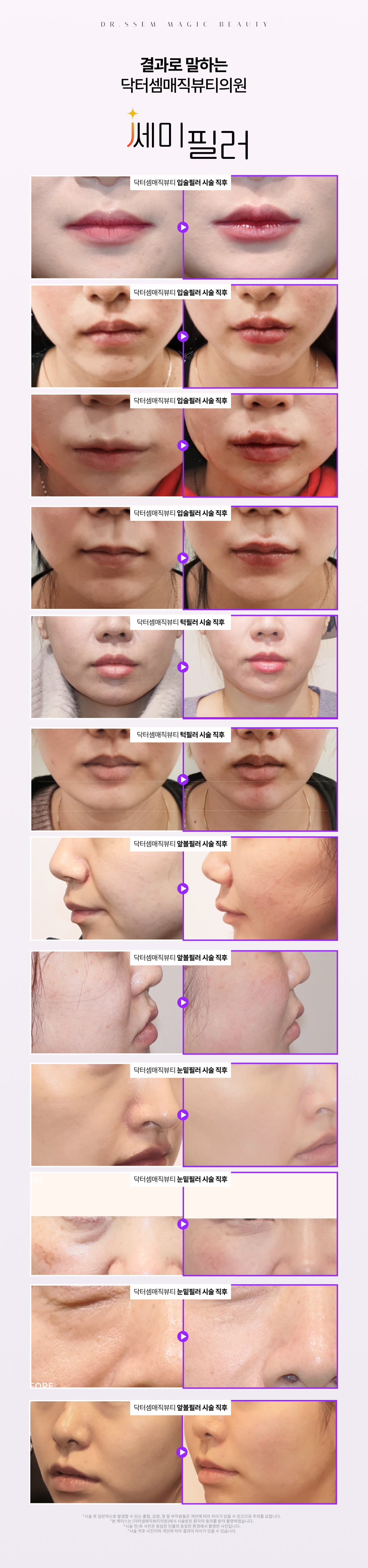 닥터셈매직뷰티 시그니처! 후기가 입증하는 필러시술을 경험해 보세요.