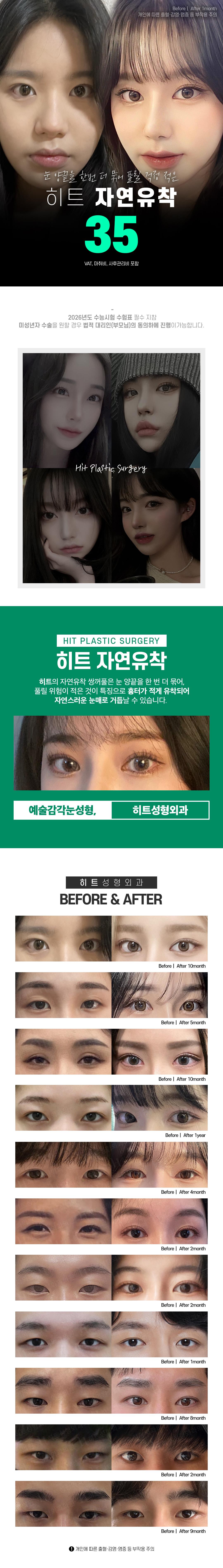 히트한 눈성형 수험생을 위한 수능이벤트 자연유착 쌍꺼풀 눈성형 매몰 