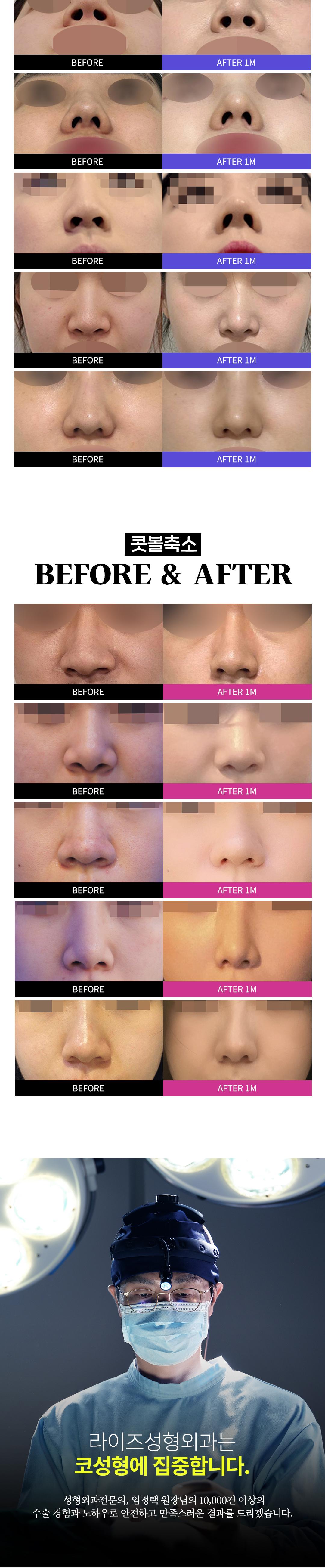 콧볼장인 임정택 원장님의 오랜 경험과 노하우로 
만족도 높은 결과를 드리겠습니다.

- 정직한 진료
- 안전한 수술
- 프라이빗한 회복실
- 1:1 맞춤상담과 디자인
- 수술시간 20분 내외 / 3일차 실밥제거 
- 사후관리 풀패키지 포함 / 추가비용 X