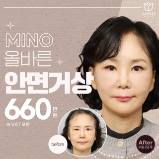 미노_올바른 안면거상