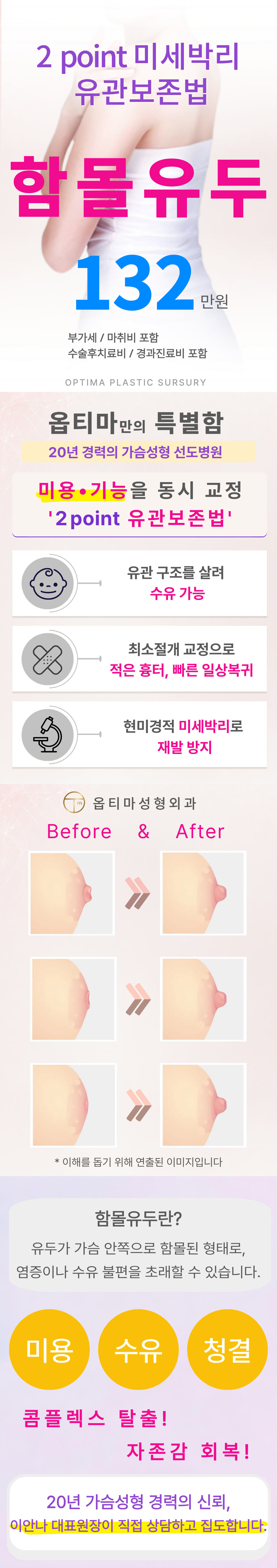 가슴안쪽으로 파뭍혀 함몰된 유두를 현미경적 정교한 미세박리로 유관구조를 보존하며 유관을 늘려주어 교정해 주는 수술입니다. 유두의 크기와 모양, 수유여부를 고려한 맞춤 수술로 자연스러운 자신감을 되찾을 수 있습니다.
20년 가슴성형 선도병원 이안나 대표원장 함몰유두 직접 상담&집도_ 2point 미세박리 유관보존법