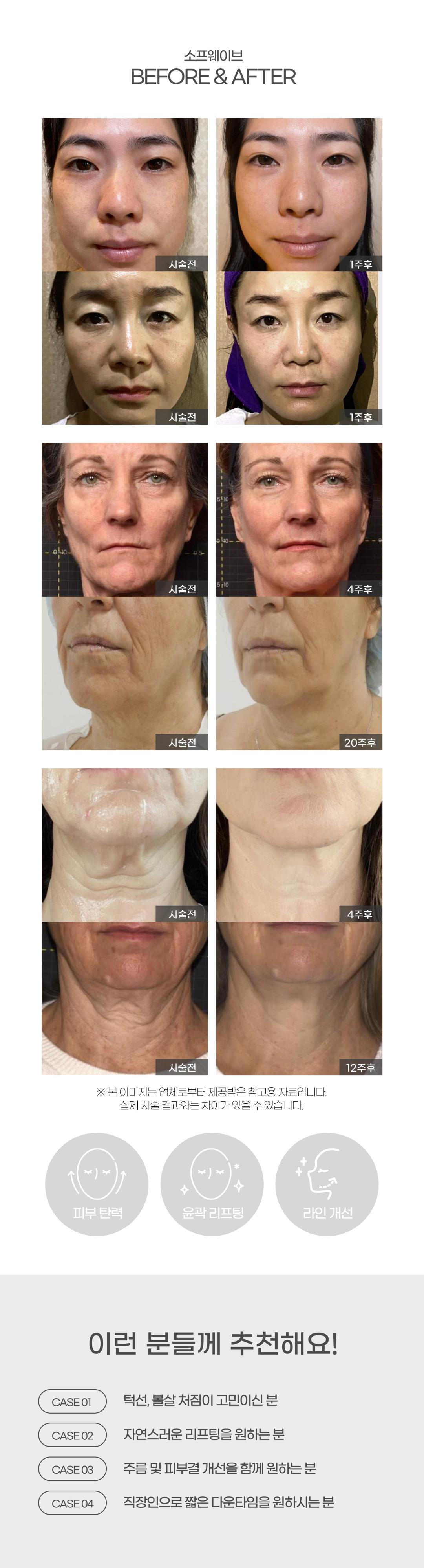 피부 속 진피층까지 강력한 초음파 리프팅, 탄력 에너지 UP

POINT
7개의 초음파 열기둥이 진피층을 정밀하게 자극해
콜라겐 재생과 엘라스틴 생성을 동시에 촉진,
피부 탄력과 리프팅 효과를 극대화

EFFECT
1회 시술만으로 느껴지는 즉각적인 탄력 개선,
이중턱·팔자·목주름까지 한 번에 케어하는
비수술 초음파 리프팅