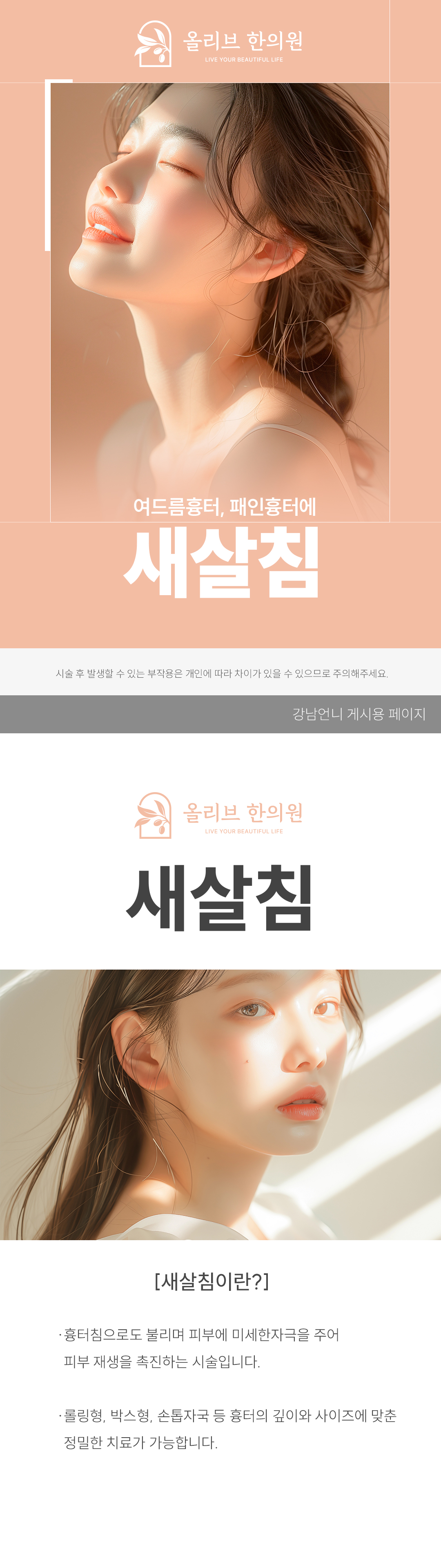 새살침이란
여드름 흉터(특히 패인 흉터, rolling/boxcar type), 오래된 흉터,  수술 흉터 등 조직이 아래로 당겨진 함몰 부위 등을 밑에서 끊어 올려주는 시술을 말합니다.

작용 원리
흉터 바닥을 아래로 잡아당겨서 패임, 함몰을 일으키는 섬유성 밴드(fibrotic tethering)를 니들을 이용해 피부 아래에서 끊어주고
피부의 상처 회복 기전을 자극하여 콜라겐 합성을 유도합니다. 
