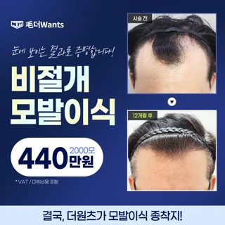 흉터 최소화, 비절개 모발이식 2000모