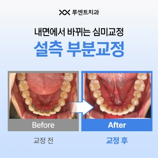 엄마도 모르는 부분 설측교정