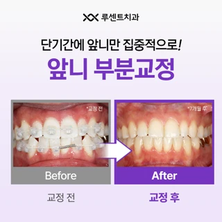 예쁘게 빠르게 앞니 부분교정