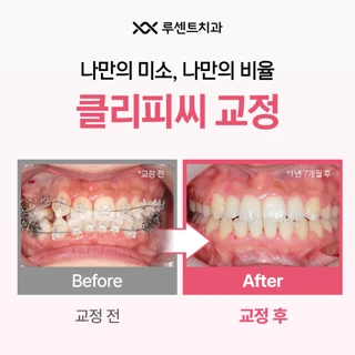 스탠다드 베스트셀러 클리피씨 치아교정