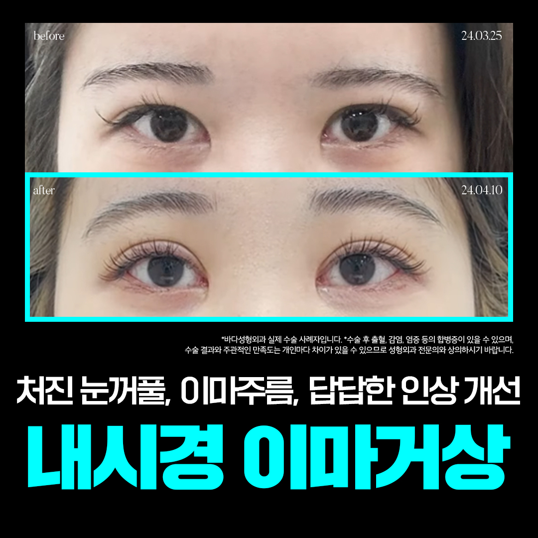 처진 이마, 눈썹, 눈꺼풀 고민_내시경 이마거상